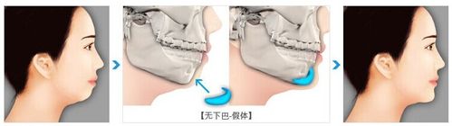 膨体垫下巴好不好 膨体垫下巴和硅胶垫下巴区别