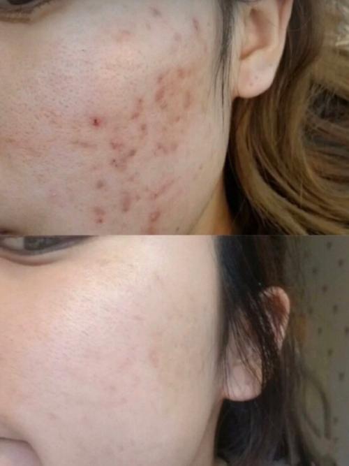 痘印颜色一开始会有些加重,这是正常现象,一周后就变淡了!