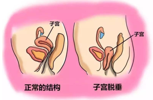 侵删   子宫脱垂是子宫从正常位置沿着阴道下降,子宫突出宫颈外口