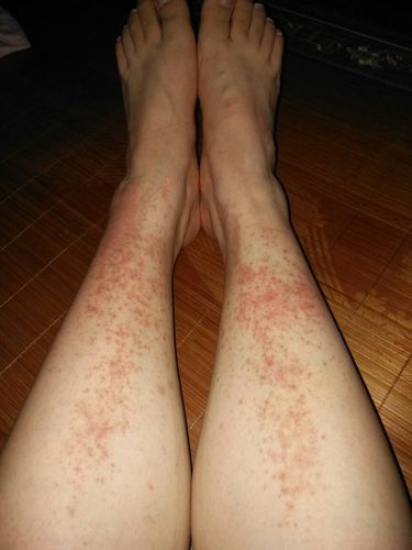 无缘无故腿上出现这些恐怖的红斑,怎么回事?
