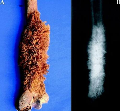 骨癌……毛茸茸的x