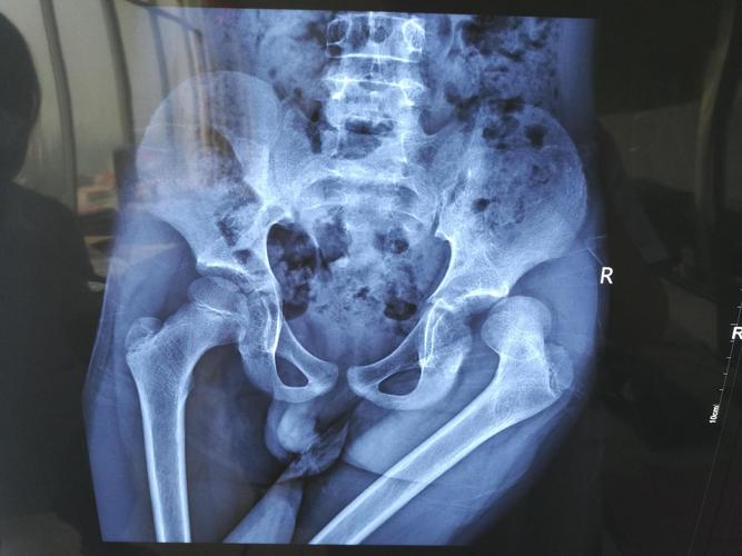 儿童髋关节脱位,复位后用牵引吗?