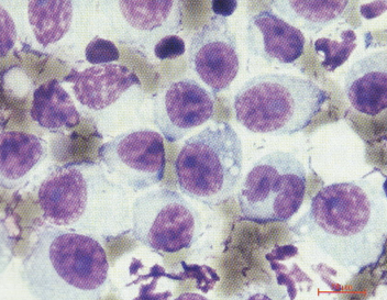 正在分裂的新生tvt肿瘤细胞,有两个核仁.(diff-quik染色)