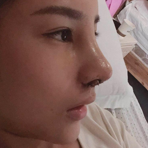 终于拆线把胶布拆了,拆线后很惊喜,鼻子改变好明显,鼻梁一点也不歪