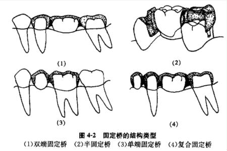 (一)双端固定桥