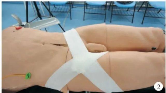 人工压迫止血02经股动脉穿刺是介入诊疗的常用途径之一,穿刺点的同