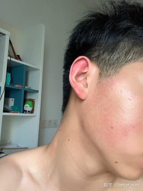 毛周角化面部红斑黑变病