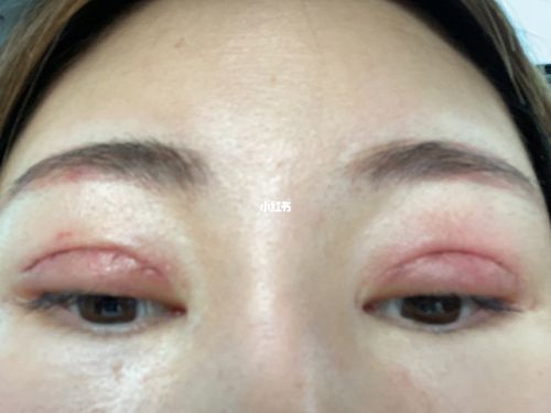 全切双眼皮术后流脓感染怎么办?
