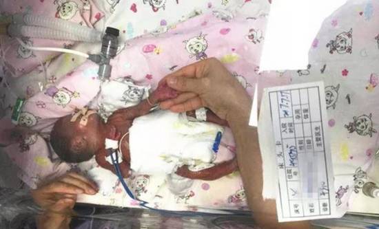 漳州一宝宝出生如矿泉水瓶大小,血管像头发丝般细!