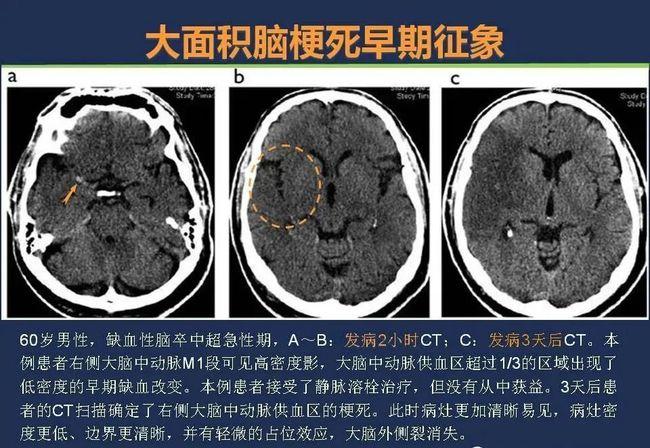 头颅ct如何预判超早期脑梗死