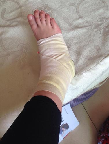 网友们大家好,我右外踝腓骨小头游离块,就是外踝撕脱骨折,我今天已经