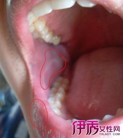 口腔有白色黏膜是怎么回事 妙招教你如何预防与治疗