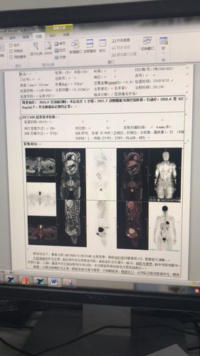 petmr对于宫颈癌患者的临床意义 - petctmr案例 - pet