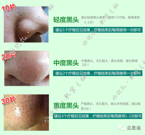 74介绍篇72水记忆的洁净去黑头鼻贴让你轻松告别草莓鼻