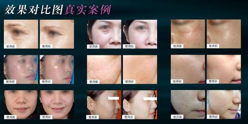 3,紧实q弹:解决女性"松"的问题,可精准作用于"中胚层",适用于紧致