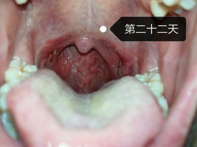 腺样体扁桃体切除术后注意事项