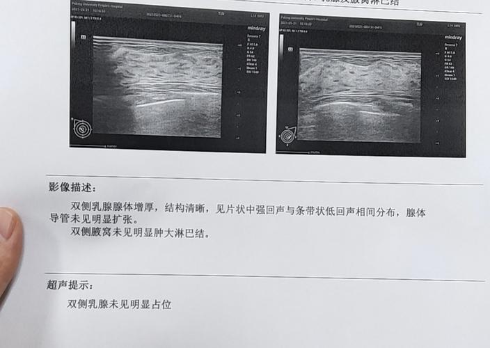 请问大家乳腺超声提示的片状强回声与条带状低回声相间分布是什么意思