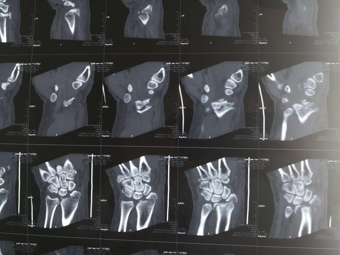 右腕部肿痛,活动障碍1天"为主诉急诊入院 查体:右手及腕关节肿胀明显