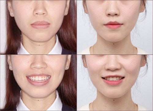 有骨性龅牙矫正案例参考吗?