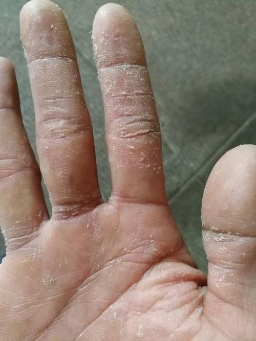 手脱皮,干裂,有水泡还会痒,要用什么药膏好呢?