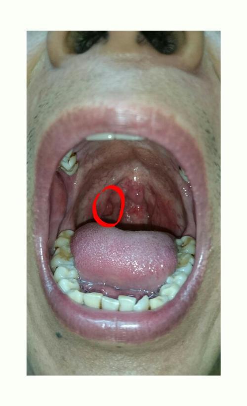 男,34岁,有19年烟龄,我在戒烟3个月后喉咙,扁桃体旁边
