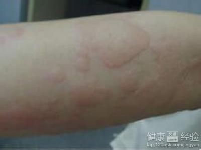 药物皮肤过敏引起什么症状