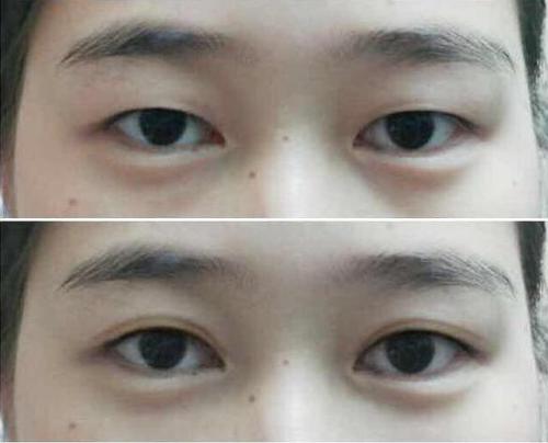 单眼皮和上眼睑下垂是同一个东西吗现在你还傻傻分不清
