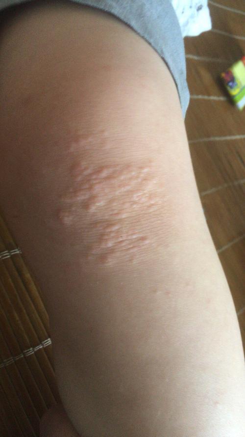 2周岁半小孩膝盖,胳膊上有疙瘩