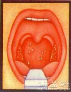 咽白喉如何诊断鉴别咽白喉易混淆疾病