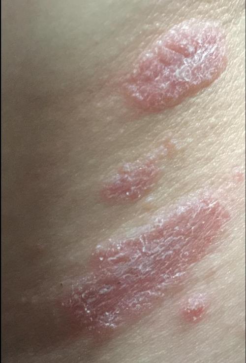 医生您好最近一周我脖子上有红斑和红点后来开始时不时的痒