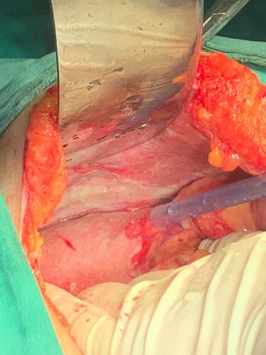 两例高风险胃穿孔病人