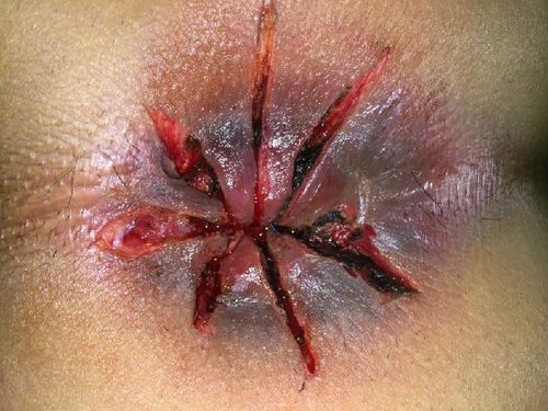 手术方式:环状混合痔分段外切内扎术(高频电刀手术),肛乳头瘤切除术