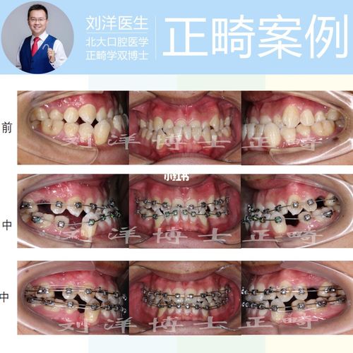 刘洋医生牙齿矫正|骨性地包天非手术纯正畸_牙齿矫正