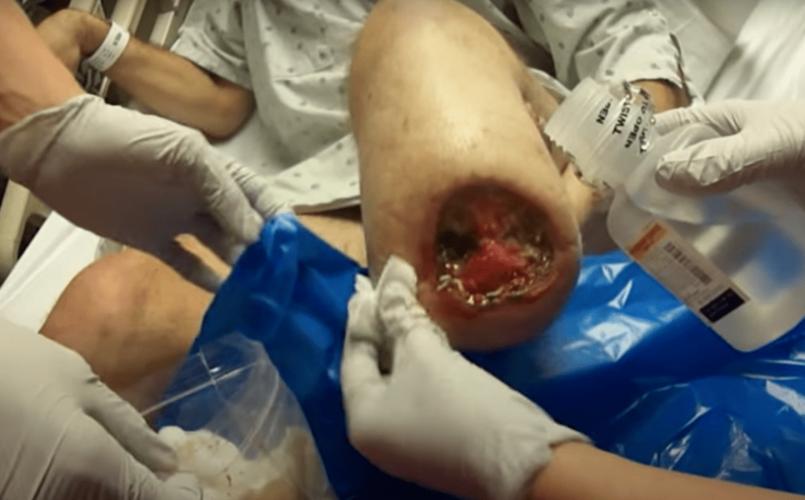 溃烂不愈的糖尿病足,竟然被「恶心」的蛆虫治好了?