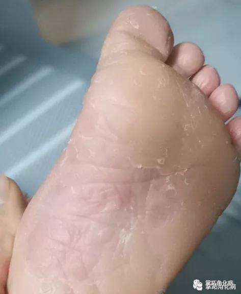手脚起皮,皮质增厚的你知道是掌跖角化症吗?