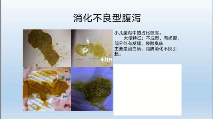 92小儿腹泻病是多种原因因素引起的,主要特点为:大便的次数增多