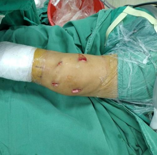 膝关节僵硬关节镜下关节清理膝关节松解术