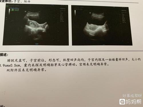 孕36天今天做了b超宫内孕囊