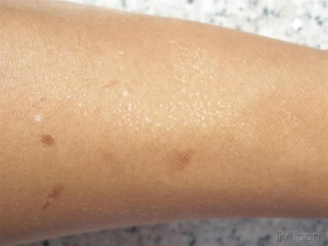 图示病例3日光疹