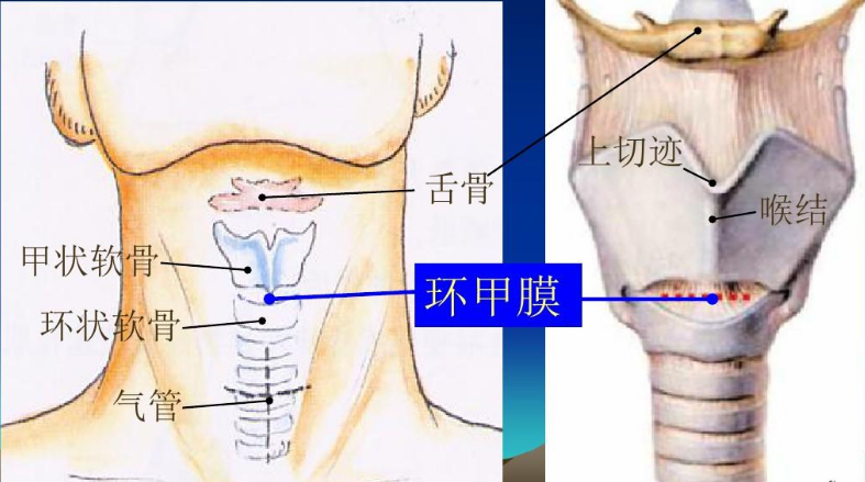 3,环甲膜穿刺:环甲膜位于喉的下方,甲状软骨和环状软骨之间,前无坚硬