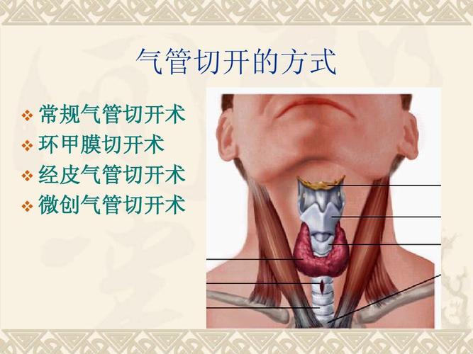 气管切开的护理及新进展ppt