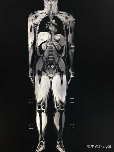基本上全身了吧 我这有个mr的,ct对骨骼高密度