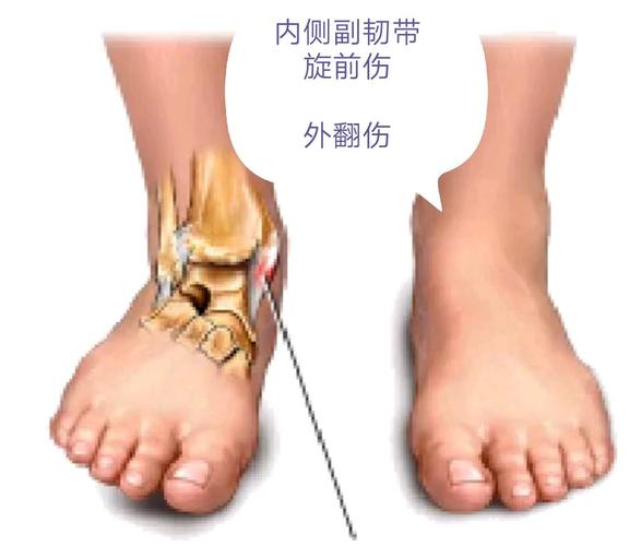 踝关节韧带损伤的修复治疗原则