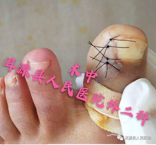 患者:张某某,女,21岁,双踇趾反复疼痛,流脓两年,曾在我科进行拔甲手术