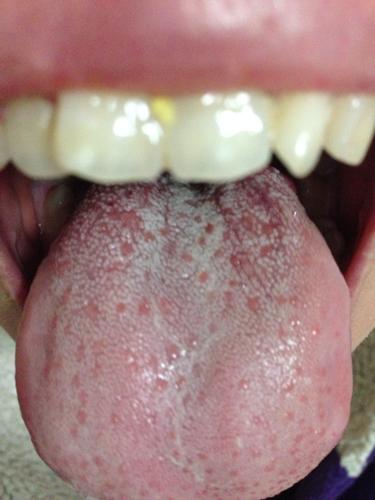 这是口腔白色念珠菌吗?还是舌苔厚重阿,自