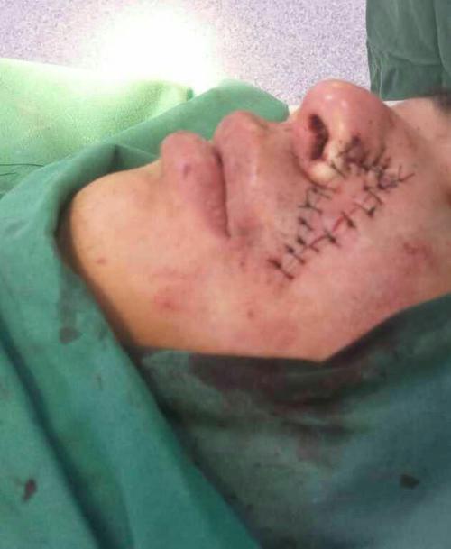 鼻唇沟"风筝"皮瓣修复面部肿瘤切除缺损创面