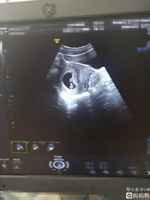孕七周加五天,好开心啊,医生说宝宝发育的很好,没有