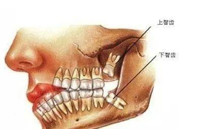 【网络辟谣】拔智齿能瘦脸?专家:这只是江湖上一个美丽的谣言