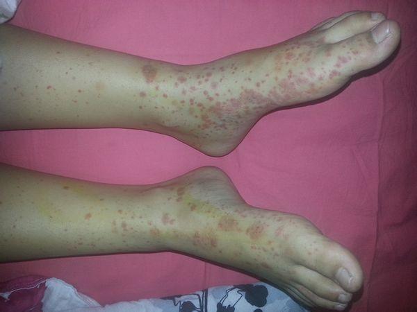 荨麻疹性血管炎症状