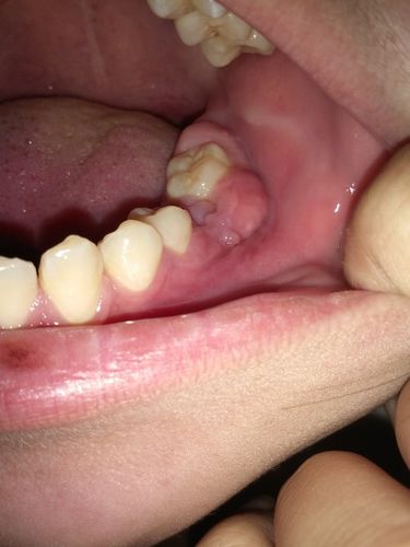 牙龈上长脓包怎么办,可以自己挑开吗